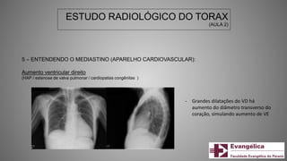 ESTUDO RADIOLÓGICO DO TORAX
(AULA 2)
5 – ENTENDENDO O MEDIASTINO (APARELHO CARDIOVASCULAR):
Aumento ventricular direito
(HAP / estenose de valva pulmonar / cardiopatias congênitas )
- Grandes dilatações do VD há
aumento do diâmetro transverso do
coração, simulando aumento de VE
 
