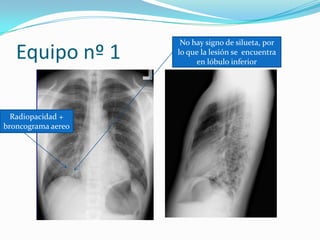 Equipo nº 1 No hay signo de silueta, por lo que la lesión se  encuentra en lóbulo inferior Radiopacidad + broncogramaaereo 