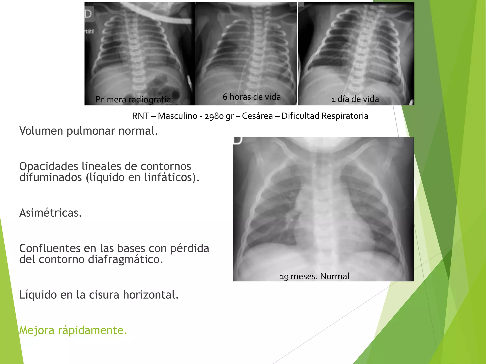 Torax en Neonatologia | PPTX