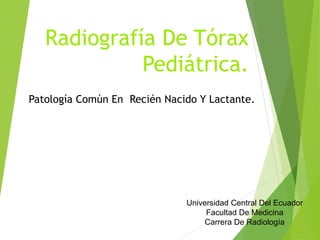Radiografía De Tórax
Pediátrica.
Patología Común En Recién Nacido Y Lactante.
Universidad Central Del Ecuador
Facultad De Medicina
Carrera De Radiología
 