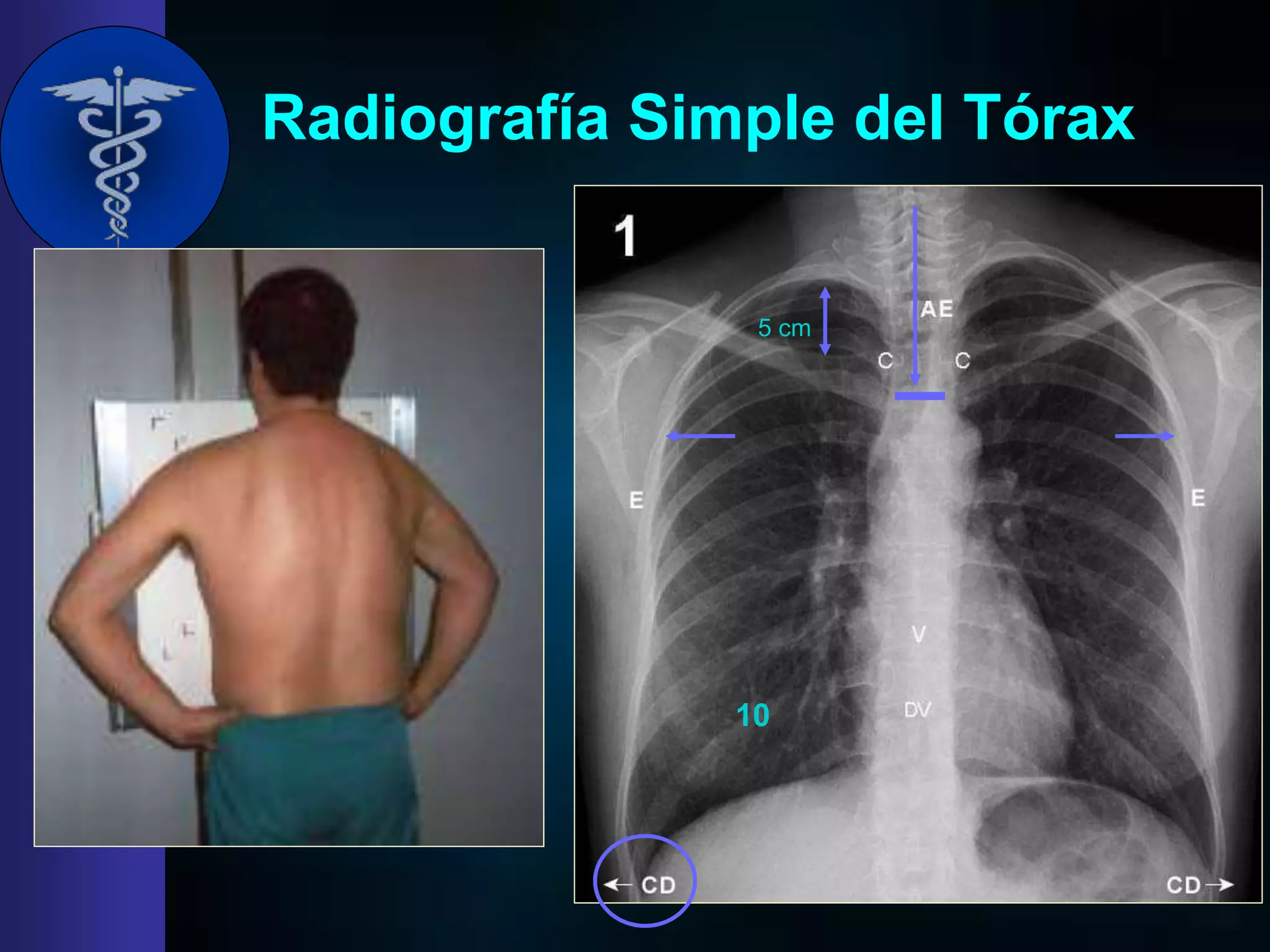 Torax Simple TORAX NORMAL EVALUACION.ppt