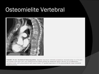 Osteomielite Vertebral
 