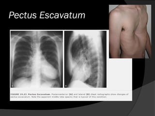 Pectus Escavatum
 