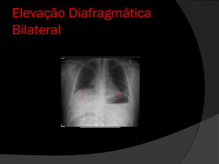 Elevação Diafragmática
Bilateral
 