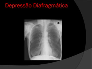 Depressão Diafragmática
 
