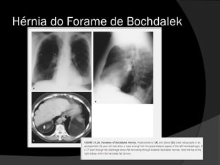 Hérnia do Forame de Bochdalek
 