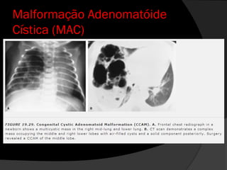 Malformação Adenomatóide
Cística (MAC)
 