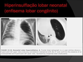 Hiperinsulflação lobar neonatal
(enfisema lobar congênito)
 
