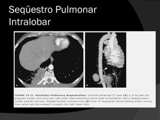 Seqüestro Pulmonar
Intralobar
 