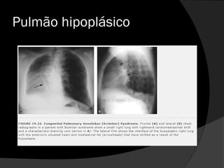 Pulmão hipoplásico
 