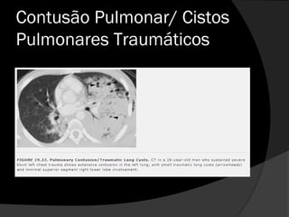 Contusão Pulmonar/ Cistos
Pulmonares Traumáticos
 
