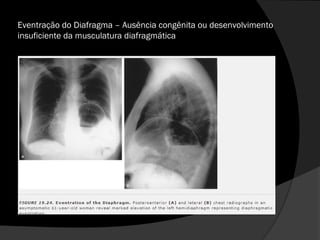 Eventração do Diafragma – Ausência congênita ou desenvolvimento
insuficiente da musculatura diafragmática
 