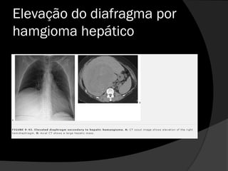 Elevação do diafragma por
hamgioma hepático
 