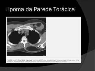 Lipoma da Parede Torácica
 