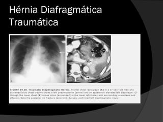 Hérnia Diafragmática
Traumática
 