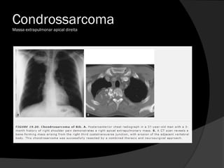 Condrossarcoma
Massa extrapulmonar apical direita
 