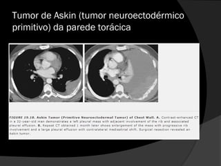 Tumor de Askin (tumor neuroectodérmico
primitivo) da parede torácica
 