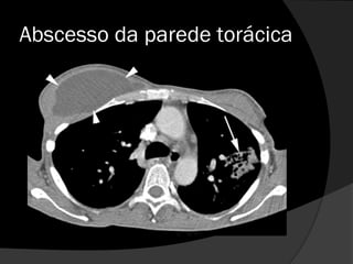 Abscesso da parede torácica
 