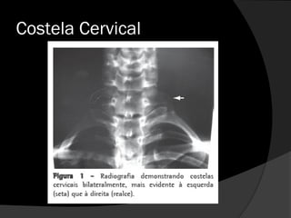 Costela Cervical
 