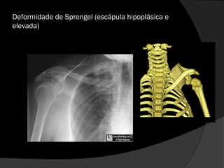 Deformidade de Sprengel (escápula hipoplásica e
elevada)
 