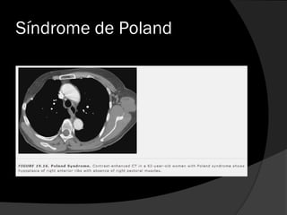 Síndrome de Poland
 