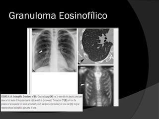 Granuloma Eosinofílico
 