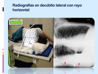 Radiografías en decúbito lateral con rayo
horizontal
 