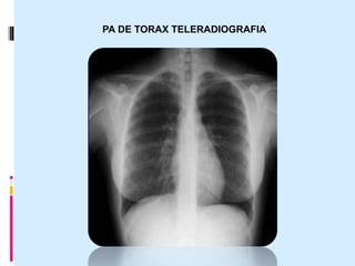 PA DE TORAX TELERADIOGRAFIA
 