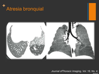 Atresia bronquial<br />Radiology: Volume 247: Number 3—June 2008<br />