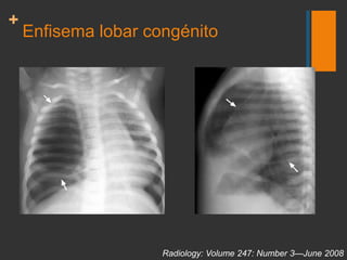 Enfisema lobar congénito<br />Sobredistensión de un lóbulo pulmonar que puede causar compresión de los lóbulos vecinos o e...