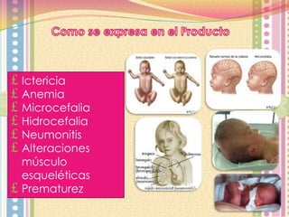 £ Ictericia
£ Anemia
£ Microcefalia
£ Hidrocefalia
£ Neumonitis
£ Alteraciones
£

músculo
esqueléticas
Prematurez

 