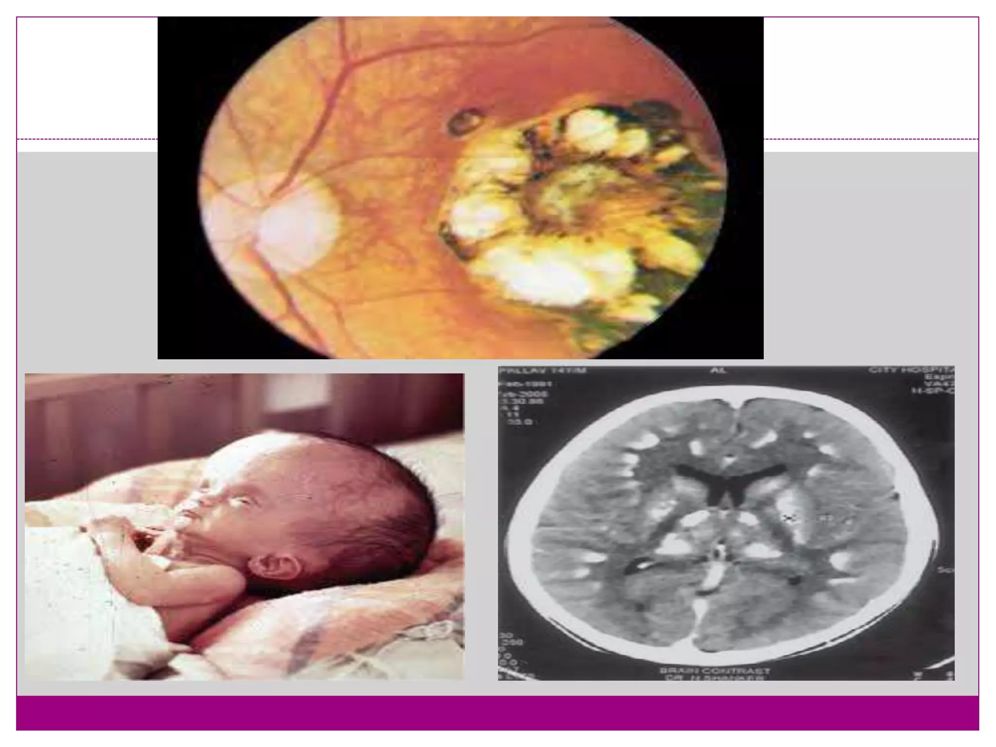 Torch infection in pregnancy PPT