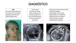 DIAGNÓSTICO
IgM
Enzimoinmunoanálisis de
los cuatro a los cinco días
después del inicio de la
enfermedad clínica
No inmunes
demuestran títulos
séricos máximos de
anticuerpo IgG una a
dos semanas después
de que comienza el
exantema
Restricción del crecimiento fetal
Ventriculomegalia
Calcificación intracraneal
Microcefalia y microftalmía
Malformaciones cardiacas
Peritonitis por meconio
Hepatoesplenomegalia
 