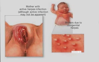 Mother with
active herpes infection
(although active infection
may not be apparent)
Blisters due to
congenital
herpes
©ADAM, Inc
 