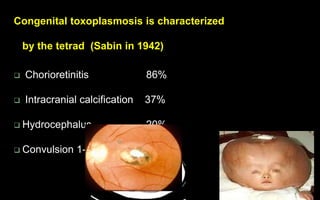 Congenital toxoplasmosis is characterized
by the tetrad (Sabin in 1942)
 Chorioretinitis 86%
 Intracranial calcification 37%
 Hydrocephalus 20%
 Convulsion 1-2%
 