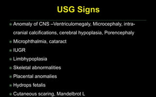  Anomaly of CNS –Ventriculomegaly, Microcephaly, intra-
cranial calcifications, cerebral hypoplasia, Porencephaly
 Microphthalmia, cataract
 IUGR
 Limbhypoplasia
 Skeletal abnormalities
 Placental anomalies
 Hydrops fetalis
 Cutaneous scaring, Mandelbrot L
 