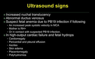  Increased nuchal translucency
 Abnormal ductus venosus
 Suspect fetal anemia due to PB19 infection if following
• An increased peak systolic velocity in MCA
• Mother is RH+
• Or in contact with suspected PB19 infection.
 In high-output cardiac failure and fetal hydrops
• Cardiomegaly
• Pericardial and pleural effusion
• Ascites
• Skin edema
• Placentomegaly
• Polyhydromios
 