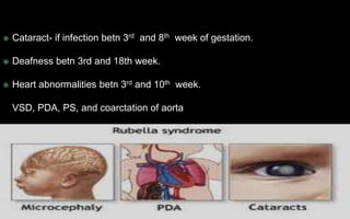  Cataract- if infection betn 3rd and 8th week of gestation.
 Deafness betn 3rd and 18th week.
 Heart abnormalities betn 3rd and 10th week.
VSD, PDA, PS, and coarctation of aorta
 