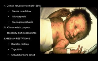 4. Central nervous system (10–25%)
• Mental retardation
• Microcephaly
• Meningoencephalitis
5. Characteristic purpura
Blueberry muffin appearance
LATE MANIFESTATIONS
• Diabetes mellitus
• Thyroiditis
• Growth hormone deficit
 