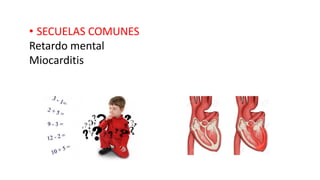 • SECUELAS COMUNES
Retardo mental
Miocarditis
 