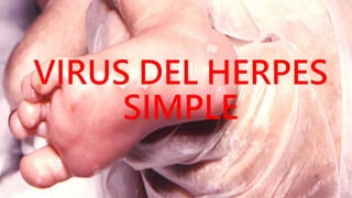 VIRUS DEL HERPES
SIMPLE
 