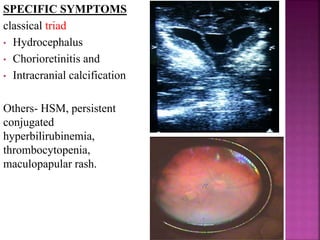(ii) Confirmatory test-
 A series of IgG tests can differentiate acute vs remote
infection.
 IgG Avidity testing- IgG produced in early infection
have low avidity but avidity increases with time. The
presence of high avidity antibodies indicates that
infection occurred 12-16 wks prior, thus helpful in early
pregnancy.
 Rising IgG titre indicates acute infection.
(B) Fetal tests-
(i) Ultrasound- monthly in suspected acute infection.
(ii) Amniotic fluid PCR- to diagnose fetal infection,
when there is serological evidence of acute infection.
 