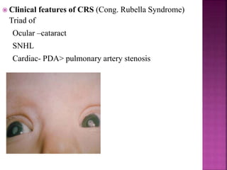 Drug Doses Side effect
Pyrimethamine
(1mg/kg/dose)
BD for 2 days
OD for 2 to 6 months then
Alternate day for next 6 months
• Bone marrow suppression
(neutropenia >>
megaloblastic anemia,
thrombocytopenia).
• GI distress
• Convulsions
• Tremor
Sulfadiazine
(50 mg/kg/dose)
BD till 1 year of age • Bone marrow suppression
• Crystalluria, Hematuria
• Hypersensitivity
Folinic acid
(10mg)
Alternate day until one week
after stopping pyrimethamine
Prednisolone
(0.5 mg/kg/dose)
BD for active CNS disease or
active chorioretinitis.
Stop when symptoms resolve
• GI distress
• Infection
• Cushingoid face
• Easy bruisability
 