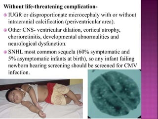 Congenital rubella infection:
i. Detection of rubella specific IgM in blood
ii. Persistent (no decline) rubella specific IgG over time
iii. Isolation of rubella virus from urine or oropharynx
secretion.
Treatment:
 No specific therapy to halt the progression of most of the
complication of CRS.
 Close follow up if early gestation infection is suspected
or the timing of infection is unknown.
 Maternal infection is confirmed
Gestation <20 wks Gestation >20wks
Discuss for MTP reassure parents, no risk of
abnormalities
 