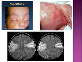 Screening:
 Because only 1-3% of women acquire primary CMV
infection during pregnancy with overall risk of symptomatic
fetal infection is only 0.2%, so screening of women at risk
generally NOT recommended.
 CDC recommendations -
• Pregnant women practice hand washing with soap and water
after contact with diapers or oral secretions and not to share
food, utensils, toothbrushes, pacifiers with children.
• Women who develop mononucleosis like illness during
pregnancy should be screened for CMV infection and
counselled about fetal risk.
• Antibody testing confirms prior infection.
• The benefits of breastfeeding overweigh the minimal risk of
acquiring CMV.
• No need to screen for CMV or exclude CMV excreting
children from schools or institutions.
 
