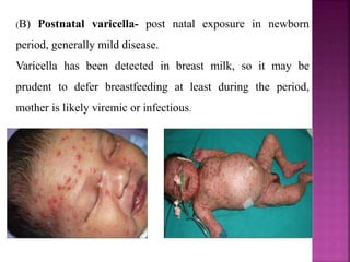 Hepatitis B vaccine schedule for infants.
From: Pickering MD, FAAP LK, editors. Red book: 2012
report of the Committee on Infectious Diseases. American
Academy of Pediatrics; 2012.
 