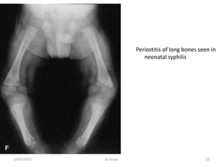 Periostitis Radiopaedia TORCH Infections.pptx