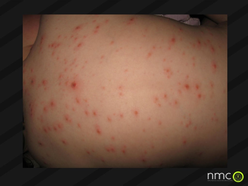 Torch infections in pregnancy presentation