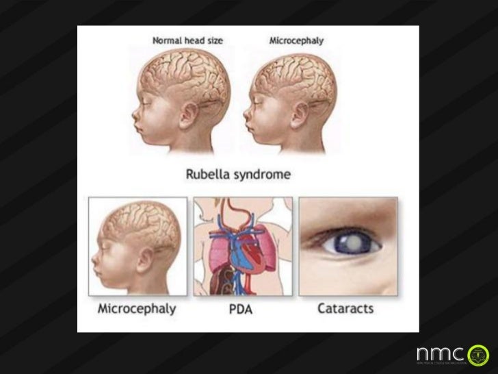 Cmv effects on fetus during pregnancy