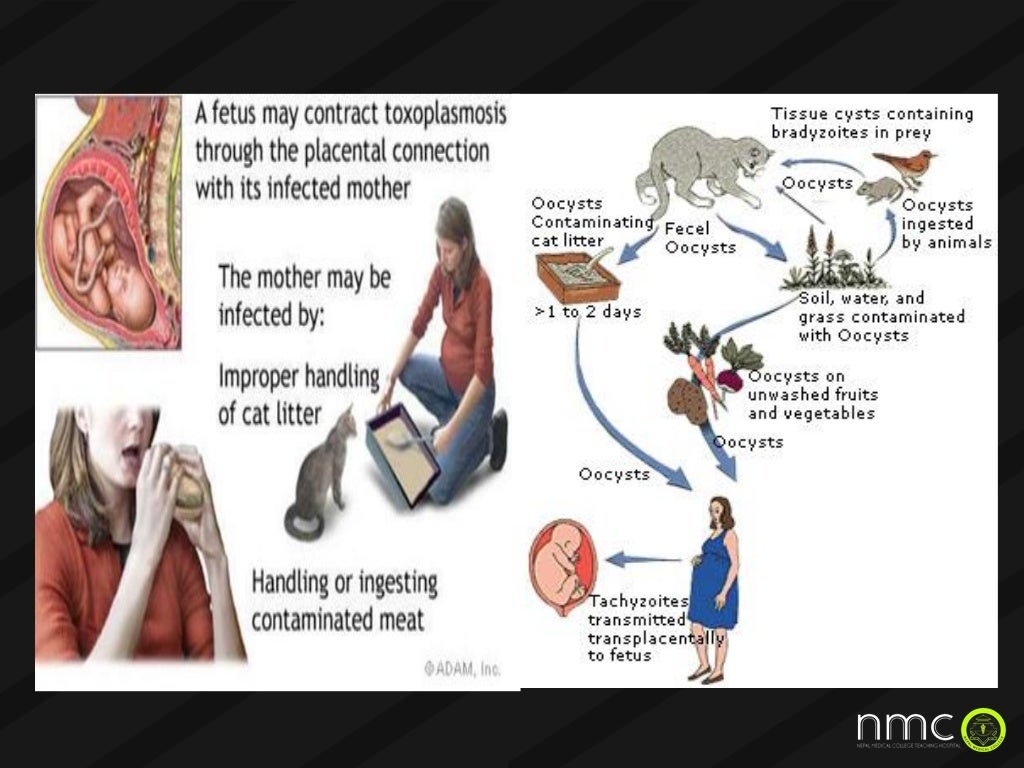 Torch infections in pregnancy presentation